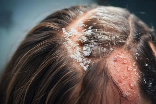 Seboreik Dermatit ve Kepeğe Karşı Etkili Bakış